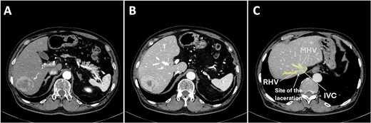 Preoperative contrast abdominal computed tomography of a hepatocellular carcinoma tumor on the posterior segment. (A) Arterial phase, (B) venous phase, and (C) right and middle hepatic vein image with the laceration site marked. Abbreviations: IVC, inferior vena cava; RHV, right hepatic vein; MHV, middle hepatic vein.