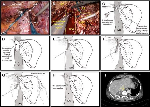 Laceration of the IVC. (A) Right liver mobilization and hanging of the RHV by laparoscopy with the laceration site marked where the small, short hepatic vein was electrocauterized. (B) Hemorrhage from the IVC injury during laparoscopic surgery. (C ) The initial laceration on the IVC was ~1 cm in size and during gauze packing a small gauze migrated into the IVC through the laceration. (D) The IVC laceration extended to the root of the RHV. The laceration was ~5 cm in length and occupied one-half of the IVC circumference. (E) The laceration was closed with two sutures at the beginning and end of the laceration. (F) Hemorrhage was minimized with finger pressure. (G) The IVC laceration was repaired with continuous sutures using 4.0 Prolene sutures. (H) The IVC injury was successfully repaired. (I) Postoperative computed tomography image showing a reduction in the IVC diameter at the hepatic vein junction by approximately one-half. Abbreviations: IVC, inferior vena cava; RHV, right hepatic vein; IRHV, inferior right hepatic vein; S7, segment 7; S8, segment 8.