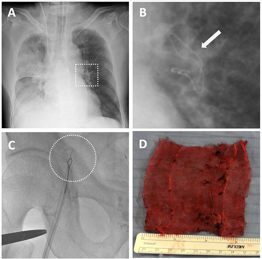 Detection of intravascular surgical gauze on radiograph and the retrieval process from the left pulmonary artery (LPA) using an endovascular technique with the right femoral vein approach. (A) X-ray image of the lung immediately after the operation. (B) The enlarged X-ray image shows the contrast of the surgical gauze at the hilum of the left lung (indicated by the arrow). (C) The snare catheter captured the surgical gauze in the LPA, passed through the right ventricle and atrium, and proceeded to the inferior vena cava and the right external iliac vein. (D) The surgical gauze was successfully retrieved through the right femoral vein.