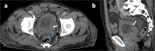 Axial (a) and sagittal (b) contrast-enhanced CT views in portal phase showing a diffuse and irregular thickening of bladder wall, pronounced on the left posterolateral side (white arrow), with invasion of the seminal vesicles and the prostate (blue arrow).
