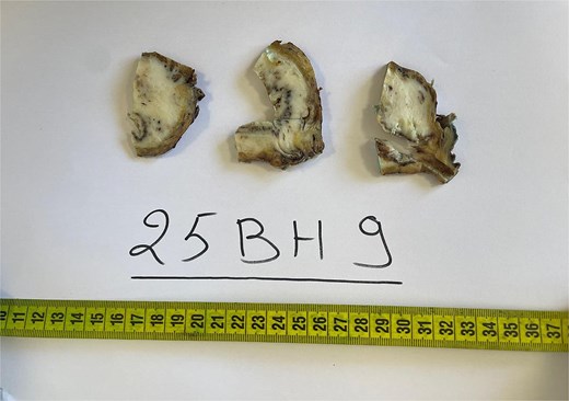 Gross appearance of the bladder tumor after sectioning, showing a solid whitish lesion invading the bladder wall.