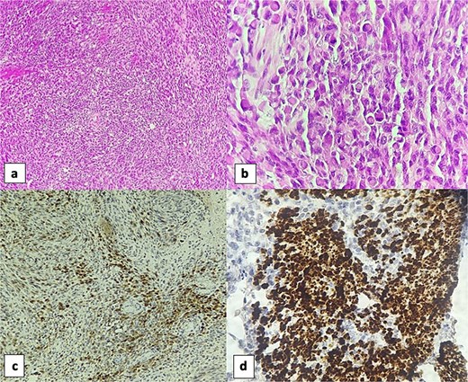 Sections of the vesical tumor revealed a proliferation of spindle cells arranged in fascicles (H&E, 4×) (a). The rhabdomyosarcomatous component was evident with numerous rhabdomyoblasts (H&E, 40×) (b). Immunohistochemically, the spindle cell component showed focal positivity for S100 protein (10×) (c). Rhabdomyoblastic component was positive for desmin (40×) (d).
