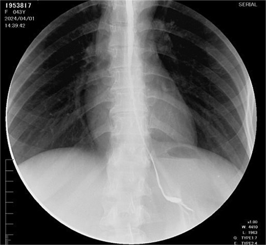 Esophagogram with esophageal stricture.