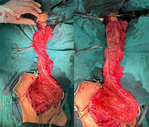 Right colonic interposition after Cattel-Braasch maneuver.