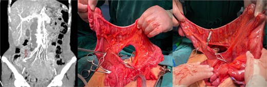 Confirmation of collateral vascular flow in the right colon (arrow shows ileocolic artery).