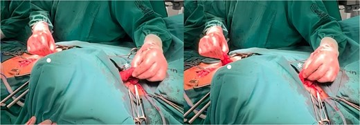 Positioning of the right colon in the posterior mediastinum, prior to the formation of the anastomoses (• abdominal/distal end of the right colon, * cervical/proximal end of the right colon).