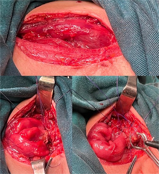 Esophagocolonic anastomosis below the hypopharynx after Orringer’s approach technique.