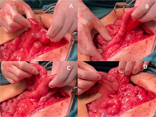 Abdominal anastomoses. (A) Colo-jejunal anastomosis, (B) alimentary loop, (C) Roux-en-Y anastomosis, (D) ileo-transverse anastomosis.