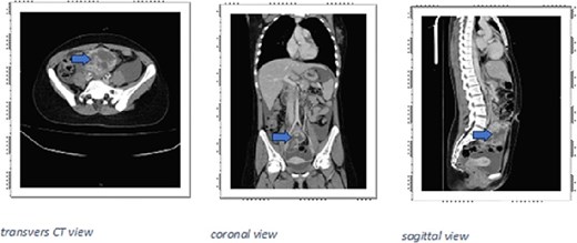 CT scan large right pelvic ill-defined heterogeneously enhancing solid-cystic mass (arrows), with hyperdensity in non-contrast study, represents hemorrhage, measuring about 9 × 9 × 9.5 cm (AP × TS × CC diameter), the mass located below the aortic bifurcation and slightly compressing the right iliac vessels.