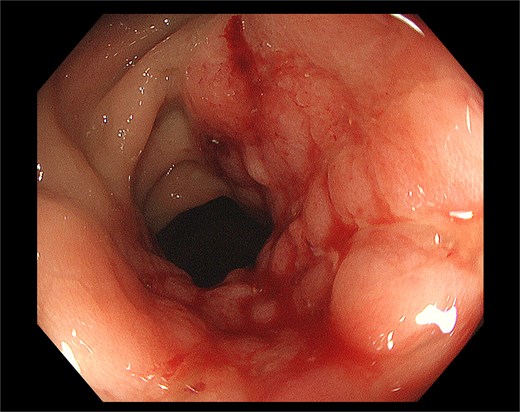Pre-operative colonoscopy identified a smoothly surfaced mass with nodular protrusions in the rectal mucosa, exhibiting features reminiscent of inflammatory bowel disease (IBD), prompting subsequent local biopsy.