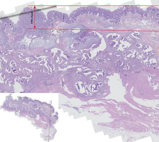 Comprehensive histological examination of the entire postoperative pathological specimen revealed that rectal mucinous adenocarcinoma (MAC) exhibited near-normal histological characteristics in the mucosal layer, with strict localization within the submucosa (the small image located in the lower left corner provides a panoramic view of the entire tissue section).