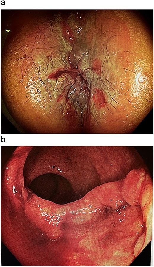 Colonoscopy images. (a) Superficial examination demonstrating circumferential perianal excoriation and ulceration. (b) Extensive colonic mucosal ulceration.