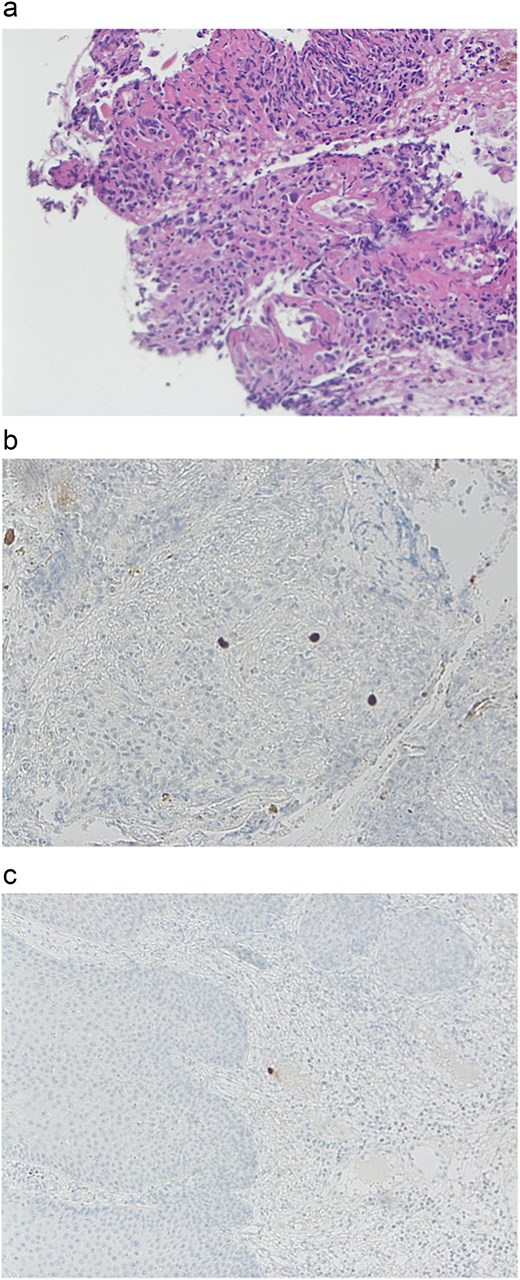 Immunohistochemistry. (a) Rectal biopsy: Large cells suggestive for CMV infection. (b) Rectal biopsy: Immunohistochemistry for CMV 10× high power. (c) Perianal biopsy: Immunohistochemistry for CMV high power.