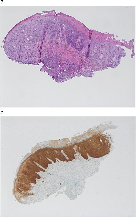 Immunohistochemistry. (a) Perianal biopsy with HISL 4× low power. (b) Perianal biopsy: p16 immunohistochemisty.