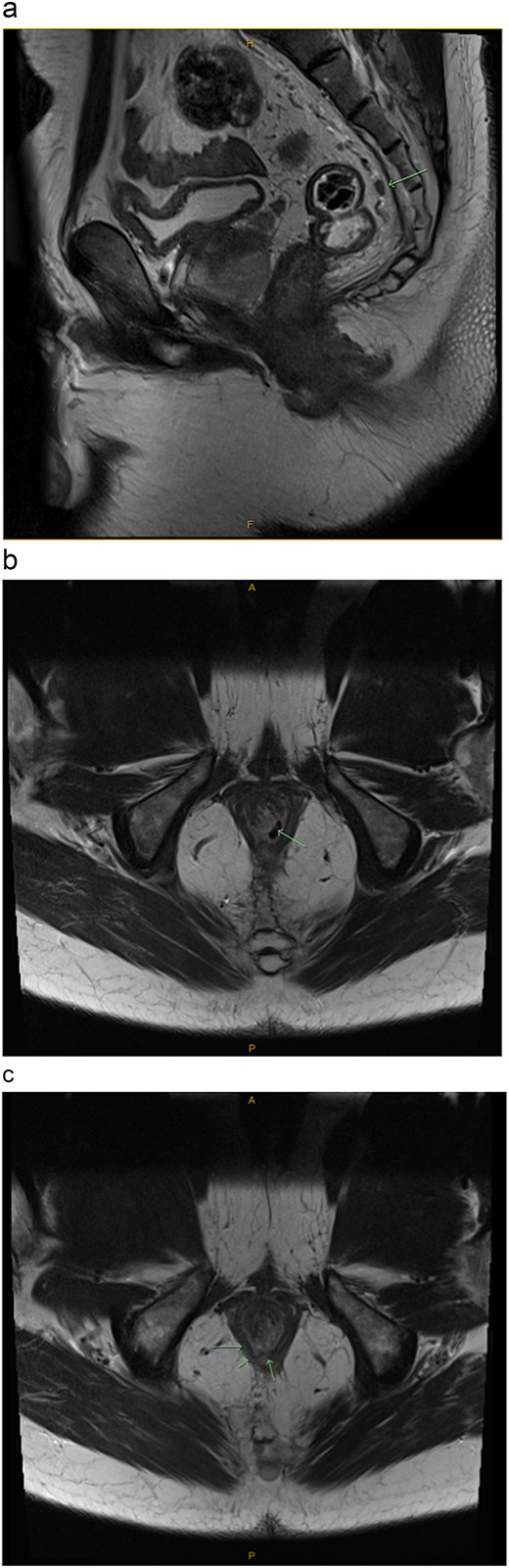 Pelvic MRI with contrast enhancement (T1 and T2 weighted imaging including DWI). (a) Sagittal view: Evidence of a single, small mesorectal lymph node (arrow), but no suspicious mesorectal lymphadenopathy. (b) Transverse view: Evidence of a single, small mesorectal lymph node (arrow), but no suspicious mesorectal lymphadenopathy. (c) Transverse view: Mucosal based high T2 signal involving the anal sphincter complex with focal induration/ulceration noted at the level of the sphincter muscle at 7 o’clock (arrows). Extension into the inferior rectus mucosa.