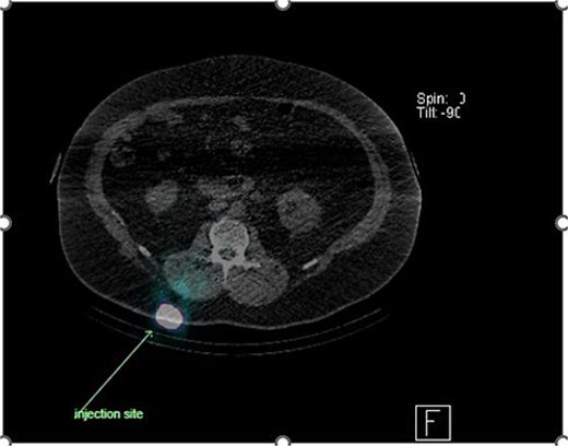 Lymphoscintigraphy showing drainage from the right lower back lesion.