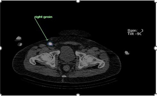 Expected drainage path toward the right inguinal lymph nodes.