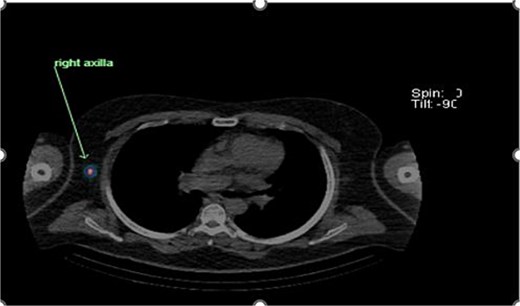 Unexpected drainage visualized toward the right axillary lymph nodes.
