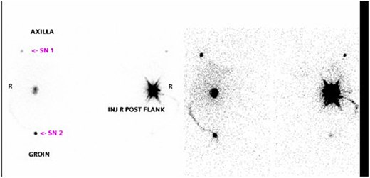Intraoperative gamma probe confirming dual drainage to axillary and inguinal regions.