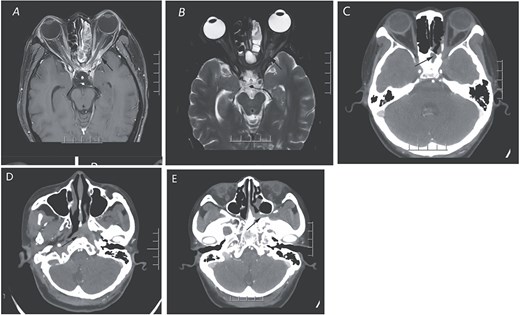 The orbital enhanced MRI scan (A and B) illustrates the presence of an enhancing inflammatory phlegmon that extends from the left sphenoid sinus through the orbital apex and involves the extraocular muscles of the left orbit. Additionally, there is an abnormal swelling of the left optic nerve. In panel C, the CT scan of the paranasal sinuses in the coronal view reveals a mass in the sphenoid sinus and posterior ethmoid sinus, along with bone destruction and a suspicious soft tissue mass affecting the left orbital apex. Panels D and E display the extension of the mass into the left pterygopalatine fossa and the presence of a suspicious soft tissue mass in the left nasopharynx, indicated by arrows.
