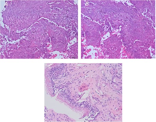 (A and B) Histopathology image of a fungal ball (aspergilloma) characterized by radiating septate hyphae and (C) chronic inflammation of the sinus mucosa (original magnification ×200).