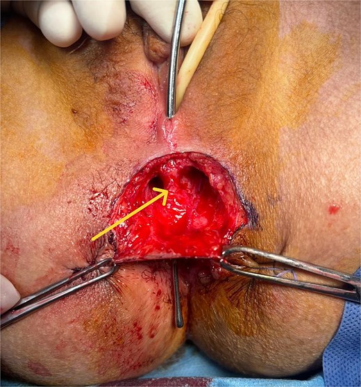 Perioperative image showing the fistulous tract after dissection of the subcutaneous tissue.