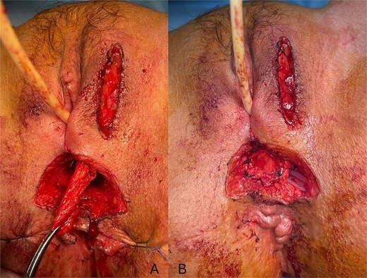 Perioperative images showing the dissection of the Martius flap (A) and its placement between the vagina and the rectum (B).