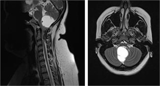 MRI brain demonstrating cystic posterior fossa mass, with solid component extending past the foramen magnum, down to the level of C3, on sagittal and axial views, respectively.