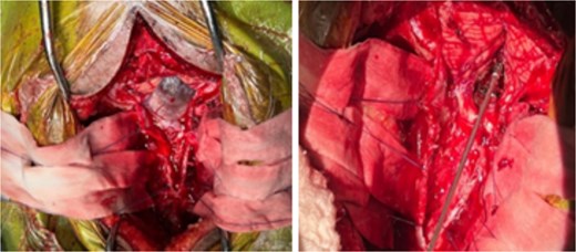 Intra-operative photography demonstrating cystic component and solid components of tumor pathologies, cyst intact, and cyst aspirated, respectively.