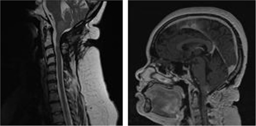 MRI brain with gadolinium, sagittal views T2- and T1-weighted, respectively, demonstrating partial resection of cystic, intra-axial component and complete resection of solid, and extra-axial component of tumor.