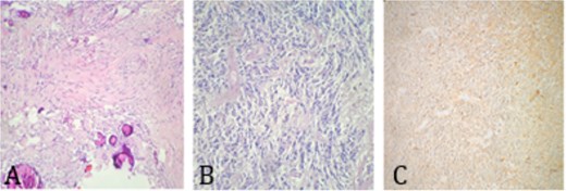 Histology imaging demonstrating. (A) Psammomatous meningioma with cellular whorls and psammoma bodies; no atypia or mitoses. (B) Low-grade glioma—a hypercellular tumor composed of glial cells with mild atypia; no necrosis and no mitosis. (C) GFAP positivity in low-grade glioma.