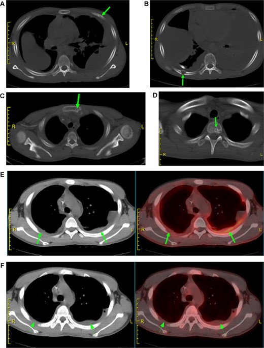 PET/CT findings of multifocal skeletal involvement and pleural abnormalities. (A–D, arrows) PET/CT scan demonstrates massive osteolytic destruction of the left 4th rib, right 8th rib, sternum, and a thoracic vertebra. (E, F, arrows) Bilateral pleural thickening with markedly increased FAPI uptake but absent FDG metabolism. Notes: (A–D) Arrows indicate sites of extensive osteolytic destruction with corresponding metabolic foci. (E) Arrow highlights FAPI-avid diffuse pleural thickening, suggestive of progressive fibrotic change. (F) Corresponding FDG-PET image shows no significant metabolic activity, emphasizing the differential diagnostic value of FAPI in this context.
