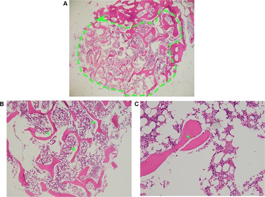 Histopathology of right iliofemoral tissue biopsied. (A, dashed outline) Low magnification shows extensive bone resorption and loss of normal bone structure. (B, arrows) high magnification displays sparse and slender bone trabeculae. (C, arrow) High magnification view highlights the area of bone microfracture. Notes: (A) Dashed outline denotes extensive osteolytic area with pathological bone loss. (B) Arrows indicate thin, attenuated, and fragmented bony trabeculae. (C) Arrow points to sites of trabecular breakdown and microstructural failure.