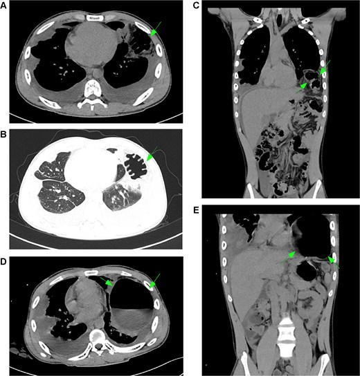 Development and progression of a left diaphragmatic hernia. (A–C, arrows) January CT scan demonstrates a newly developed left diaphragmatic hernia with herniation of abdominal contents into the thoracic cavity. (D, E, arrows) Follow-up CT scan in March shows significant progression of the herniation with increased volume of herniated content and more pronounced displacement of thoracic structures. Notes: (A–C) Arrows indicate the initial presentation of the left diaphragmatic defect, showing herniation of the omentum and bowel loops. (D, E) Arrows highlight interval progression, demonstrating substantial enlargement of the hernia sac and increased mass effect on the adjacent lung parenchyma.