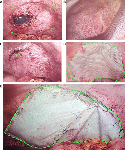 Intraoperative findings and repair of left diaphragmatic hernia. (A, arrows) The left diaphragm demonstrates a 20 × 18 cm attenuated zone and a 6 × 5 cm distinct defect. (B) The intact right diaphragm is shown for comparison. (C, arrow) Primary suture repair of the diaphragmatic defect following lung re-expansion. (D, dashed outline) Placement of a prosthetic mesh over the attenuated area for reinforcement. (E, dashed outline) A biological barrier is fixed over the mesh to prevent adhesions. Notes: (A) Arrows point to the thinned, weakened diaphragmatic area and the full-thickness defect. (C) Arrow indicates the suture line after primary closure of the hernia. (D) Dashed outline highlights the positioned mesh covering the reinforced area. (E) Dashed outline shows the overlying biological barrier that minimizes adhesion risks.