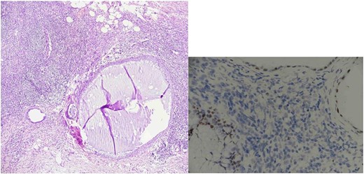 Lymph node endometriosis. Lymph node number 1, A: Hematoxylin/eosin stain × 40; B: Estrogen receptor immunostaining × 200.