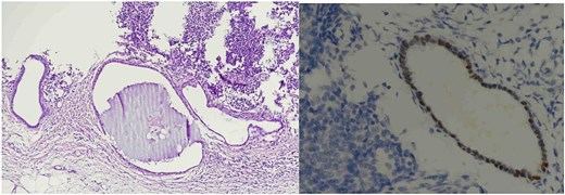 Lymph node endometriosis. Lymph node number 2, A: Hematoxylin/eosin stain × 100; B: Estrogen receptor immunostaining × 400.