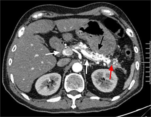 Enhanced CT showed tortuous dilated arteries in the pancreas body and tail (black arrow) with a small pseudocyst (red arrow) and early opacification of the splenic vein and portal vein (white arrows).
