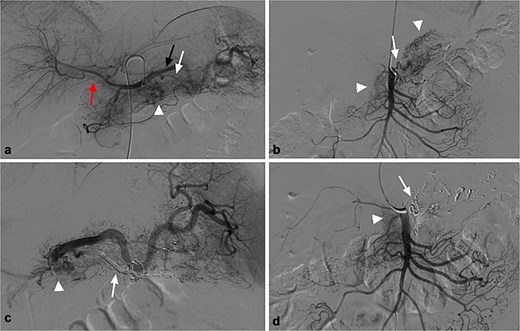(a) Celiac angiography showed PVAM (white arrowhead) with numerous fine feeders mainly originating from splenic artery (black arrow) and great pancreatic artery (white arrow), as well as early portal vein opacification (red arrow). (b) Superior mesenteric angiography shows other fine feeders mainly originating from one branch of superior mesenteric (white arrow) artery with PVAM (white arrowhead). (c) Post embolization angiogram of splenic artery shows occlusion of great pancreatic artery (white arrow), and minimal residual staining of the pancreas (white arrowhead). (d) Post embolization angiogram of the supplying branch shows occlusion of the concerned artery (white arrow) and minimal residual staining of the pancreas (white arrowhead).