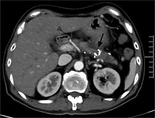 Postembolic enhanced CT after 7 months showed disappearance of PAVM with high-density spots (NBCA) in the pancreas (black arrow).