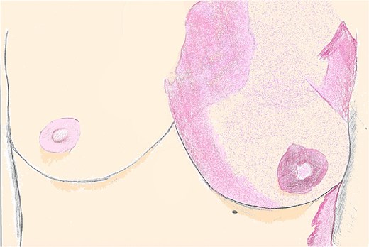 An illustration of bilateral breasts seen in the preoperative setting, with the CVM distribution seen across the left chest, and its absence across the right chest wall.