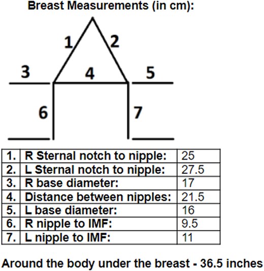 Preoperative breast measurements.