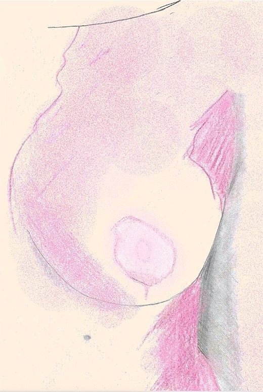 An illustration of the left breast 12 weeks postoperative, fully re-epithelialized with preservation of contour, projection, and minimal hypopigmentation.