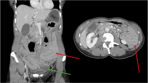 CT scan. Green arrow shows free fluid. Red arrows show diffusely thickened bowel wall.