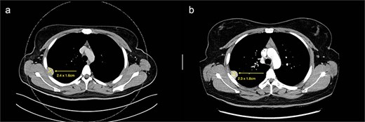 (a) Axial cut of CT thorax taken in April 2024, depicting a right sided hyperdense peripheral pleural lesion measuring 2.4 × 1.6 cm. (b) Axial cut of a repeat CT thorax taken in February 2025, showing the same hyperdense pleural lesion relatively stable in size, now measuring 2.3 × 1.8 cm.