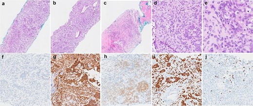 Histological findings of the tumour. (a–c) Haematoxylin and eosin stained sections demonstrating the variety of architectural patterns in the tumour (50× magnification). (d and e) Higher-power photomicrographs demonstrating cellular morphology and cells with clear cytoplasm (D-200× magnification, E-400× magnification). (f–j) Immunoperoxidase stained sections with antibodies for AE1/3 (f), CD56 (g), S100 (h), SOX10 (i), and Ki67 (j) (100× magnification).