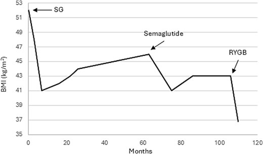 Trajectory of BMI loss over time after sleeve gastrectomy (SG) and Roux-en-Y gastric bypass (RYGB).