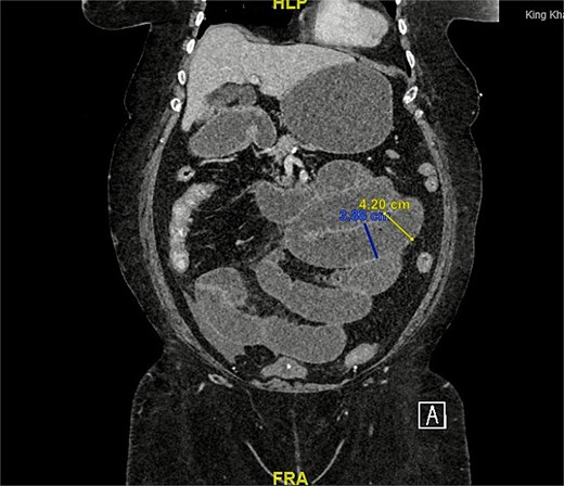 CT scan coronal view: Demonstrating distended small bowel loops consistent with small bowel obstruction, with a transitional zone at the twist of bowel over the suprapubic catheter.