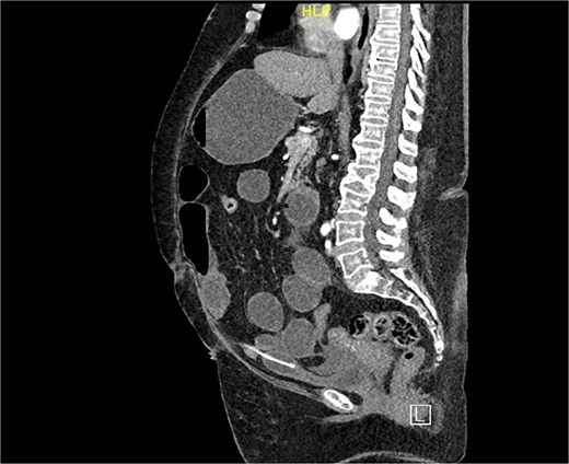 CT scan sagittal view: Demonstrating suprapubic catheter in its appropriate position within the bladder.