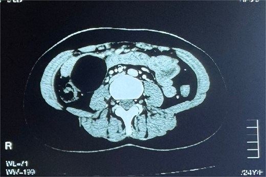 Contrast-enhanced CT scan of the abdomen showing a well-defined, rounded cystic lesion with enhancing walls in the right hemi-abdomen, abutting adjacent small bowel loops.